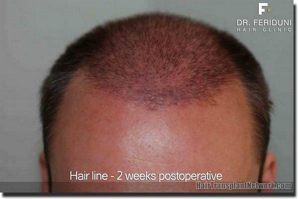 Hair restoration procedure results