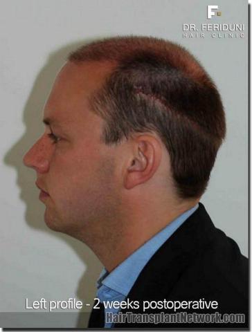 Hair restoration procedure results