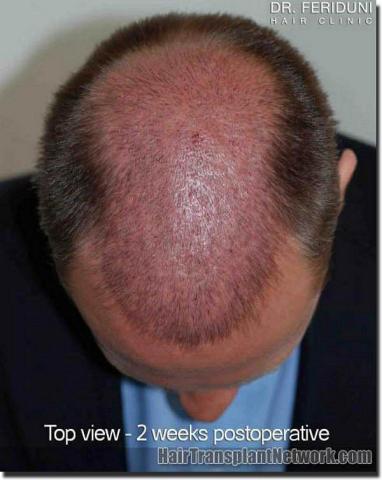 Hair restoration procedure results