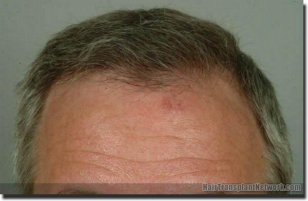 Hair restoration procedure results