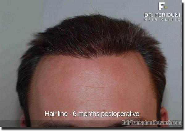 Hair restoration procedure results