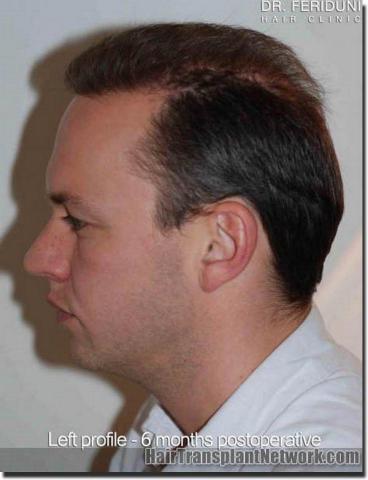 Hair restoration procedure results