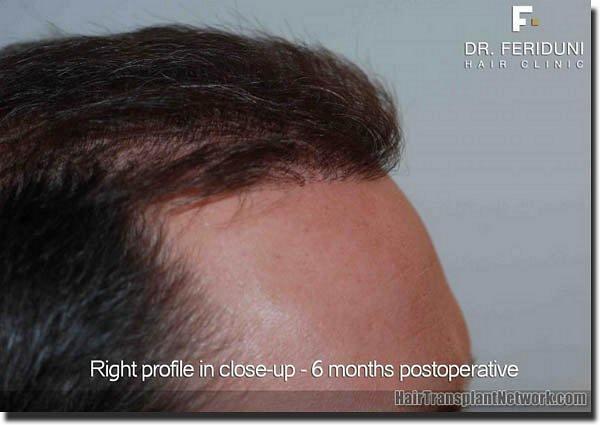 Hair restoration procedure results