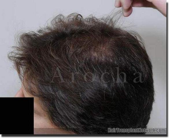 Hair restoration procedure results