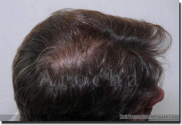 Hair restoration procedure results