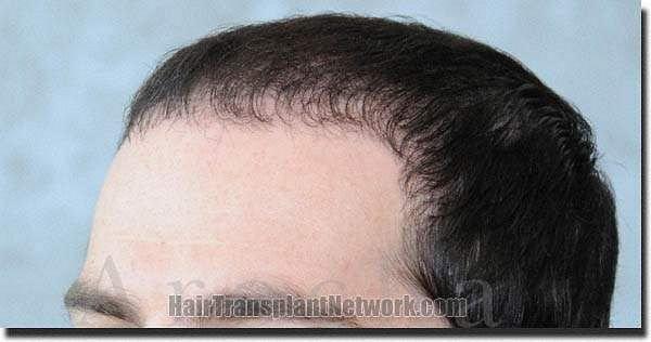 Hair restoration procedure results