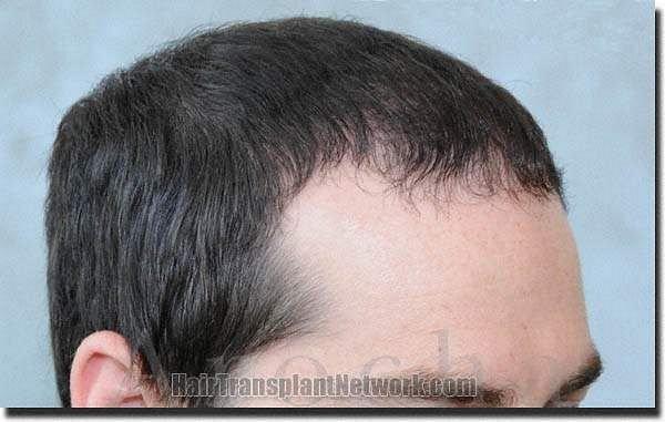 Hair restoration procedure results