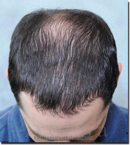 Hair restoration procedure results