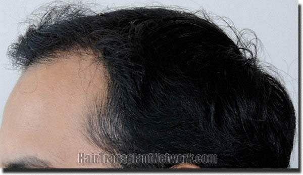 Hair restoration procedure results