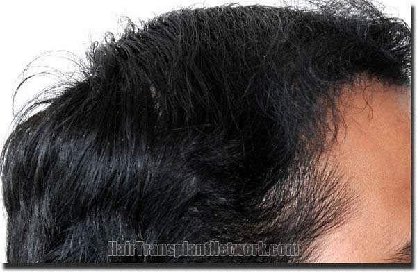 Hair restoration procedure results