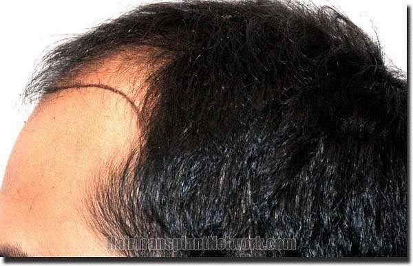 Hair restoration procedure results