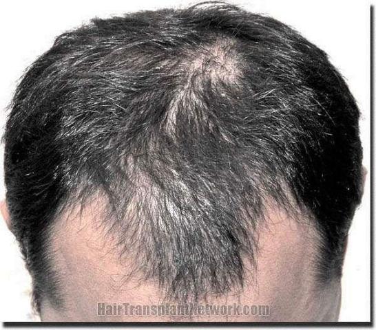 Hair restoration procedure results