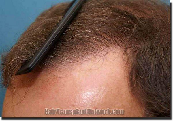 Hair restoration procedure results