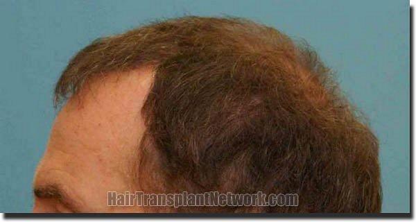 Hair restoration procedure results