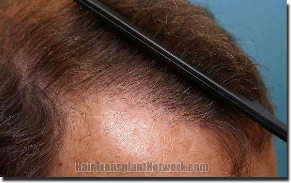 Hair restoration procedure results