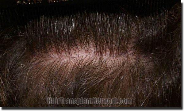 Hair restoration procedure results