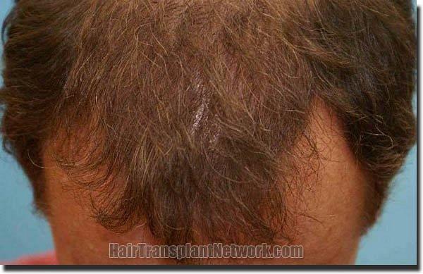 Hair restoration procedure results