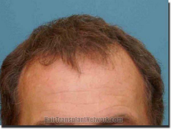 Hair restoration procedure results