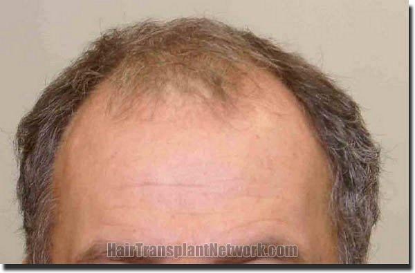 Hair restoration procedure results