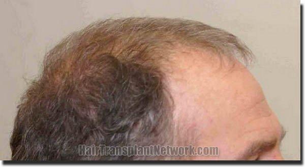 Hair restoration procedure results