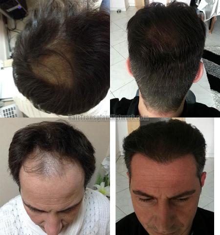 Hair restoration procedure before and after pictures