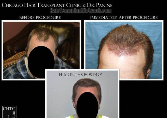 Hair transplantation surgery before and after images