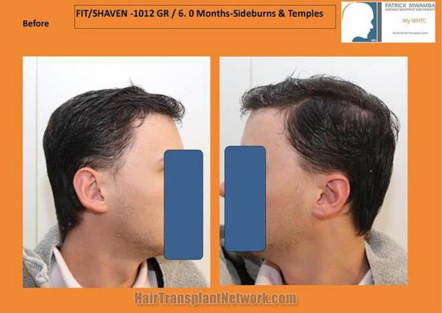 Hair restoration procedure before images
