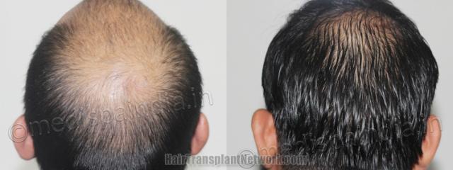 Back view before and after hair transplantation 