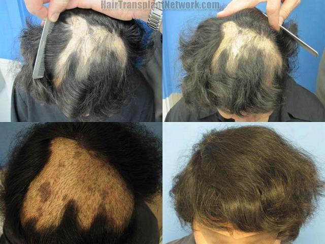 Hair restoration photos of a burn victim before and after