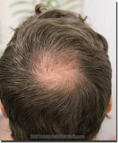 Hair restoration procedure results