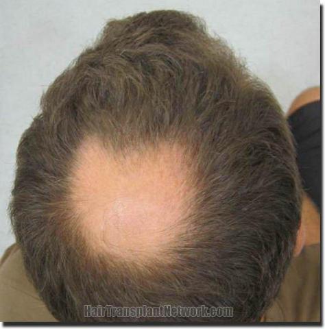 Hair restoration procedure results