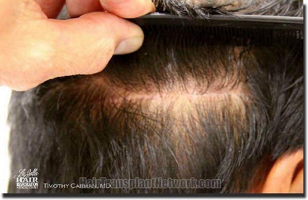 Hair restoration procedure results