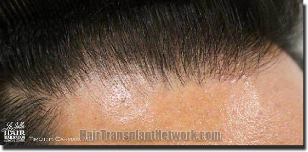 Hair restoration procedure results