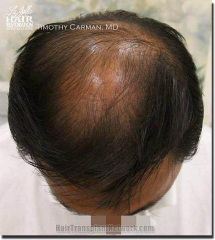 Hair restoration procedure results