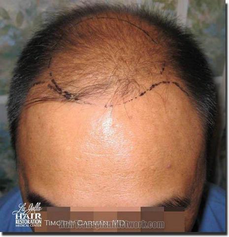 Hair restoration procedure results