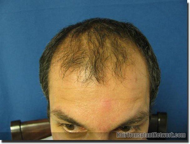 Hair restoration procedure results