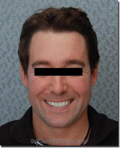 Hair restoration procedure results