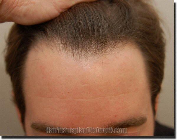 Hair restoration procedure results