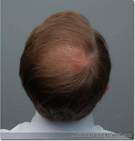 Hair restoration procedure results