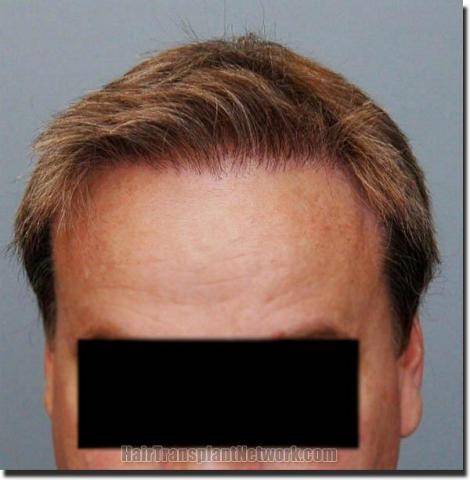 Hair restoration procedure results