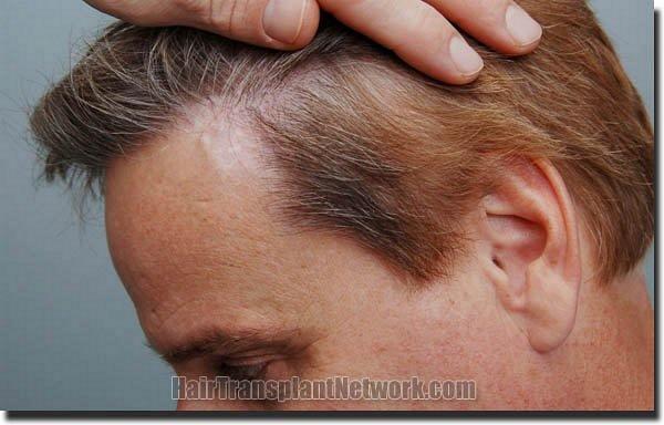 Hair restoration procedure results