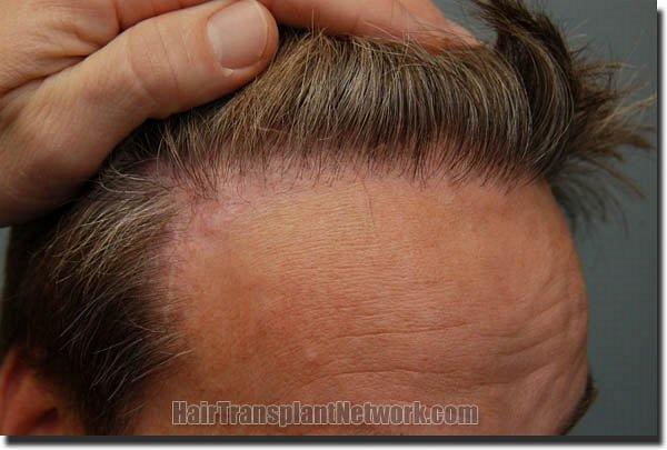 Hair restoration procedure results