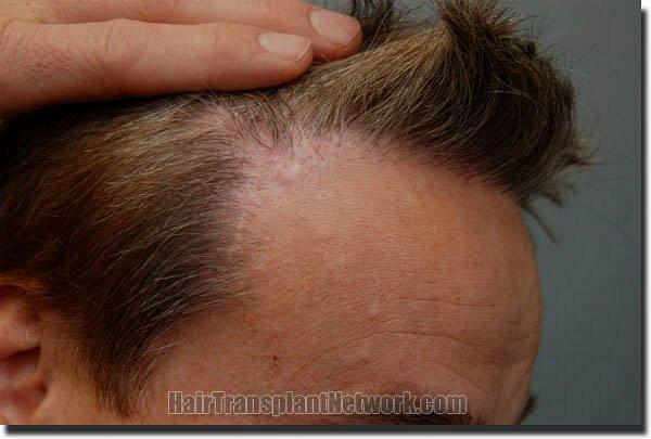 Hair restoration procedure results