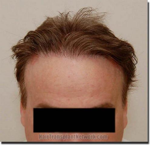 Hair restoration procedure results