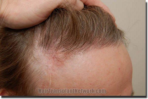 Hair restoration procedure results