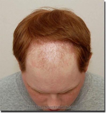 Hair restoration procedure results