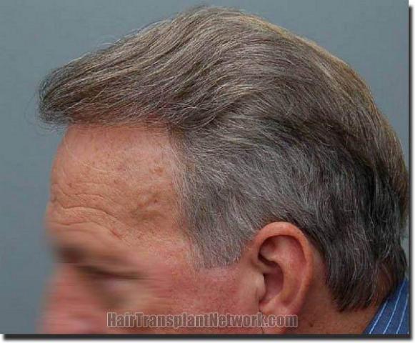 Hair restoration procedure results