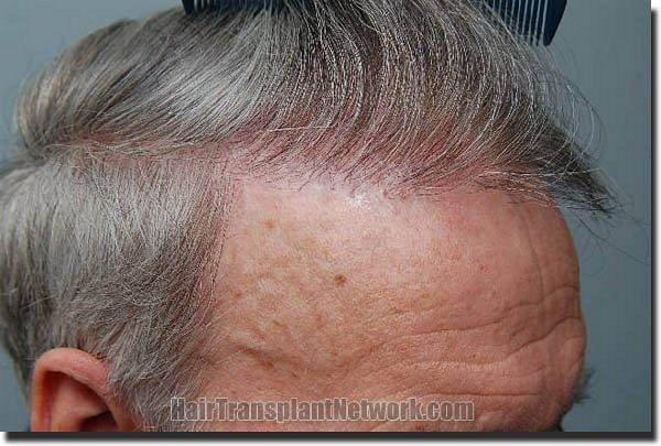 Hair restoration procedure results