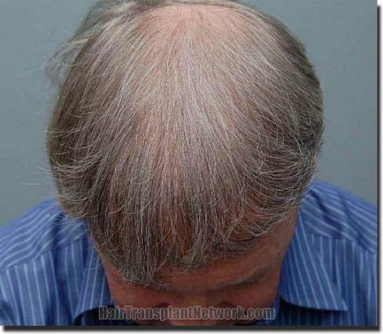 Hair restoration procedure results