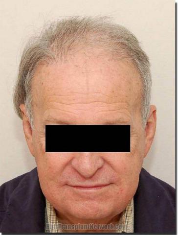 Hair restoration procedure results